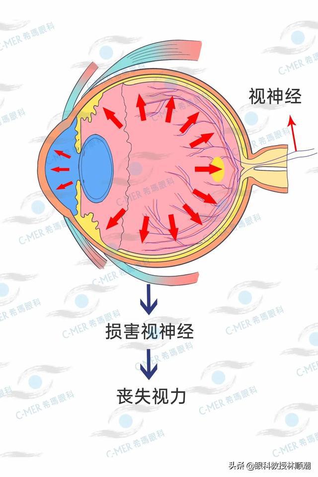 喝奶茶喝进ICU！广东29岁女生被诊断为爆发型糖尿病(图3)